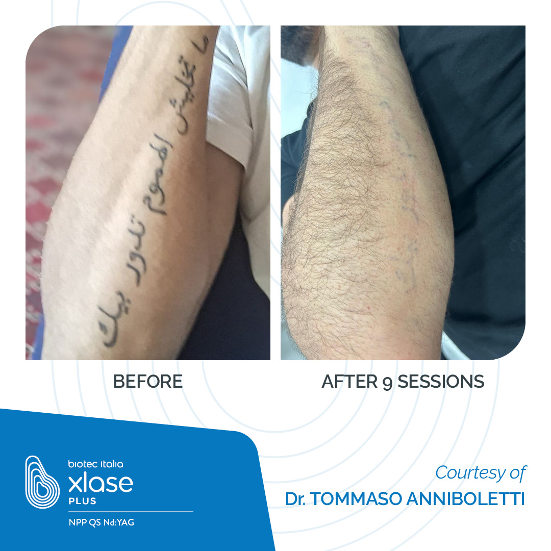 Before and after Tattoo removal with NPP laser